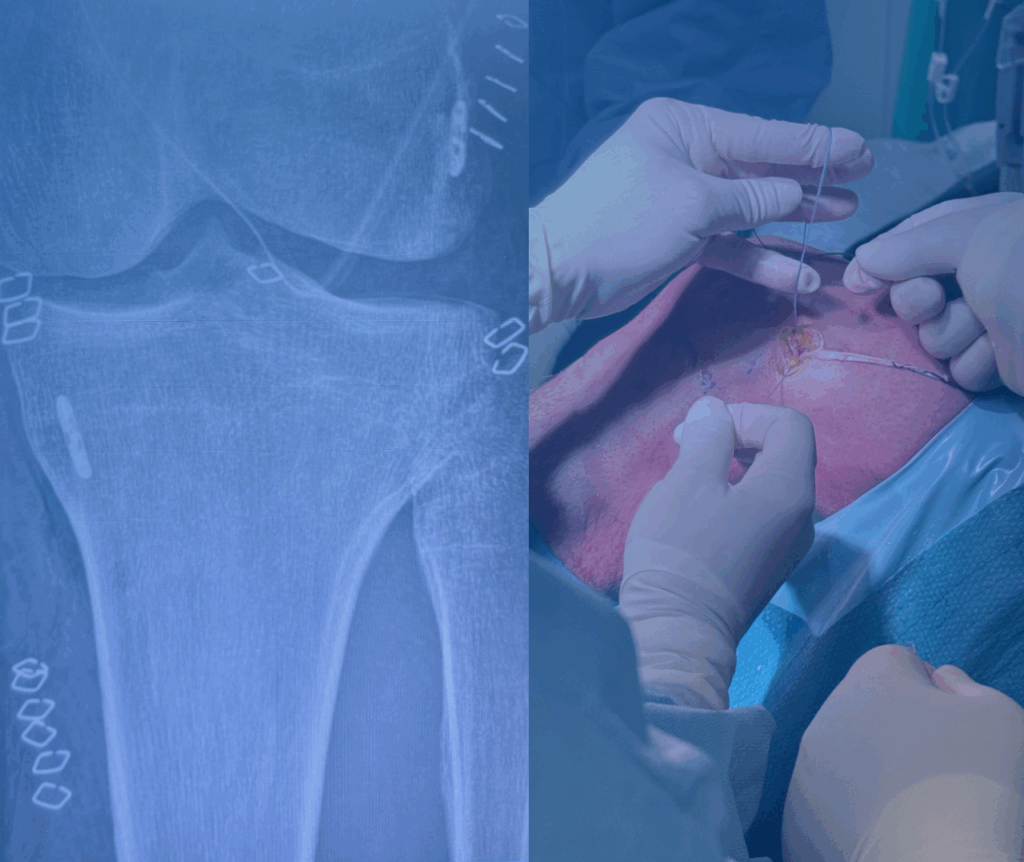 Ricostruzione del Crociato Anteriore con Tecniche All-Inside e GRAAL