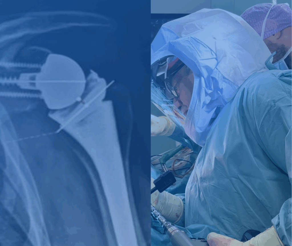 Lesioni irreparabili della cuffia dei rotatori: quando la Protesi di Spalla?