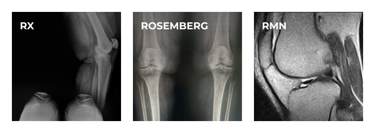 Chirurgia robotica Protesi ginocchio