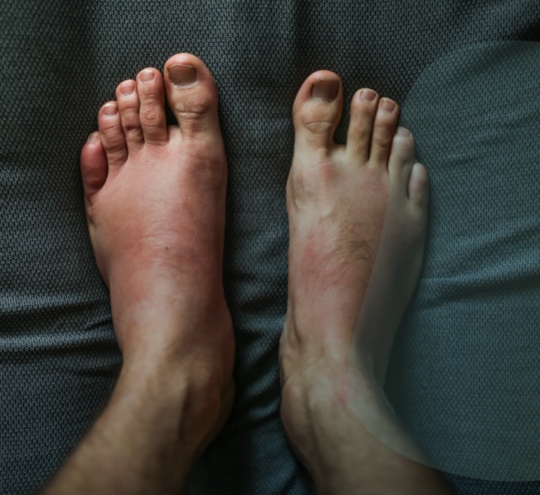 Sindrome di Muller Weiss