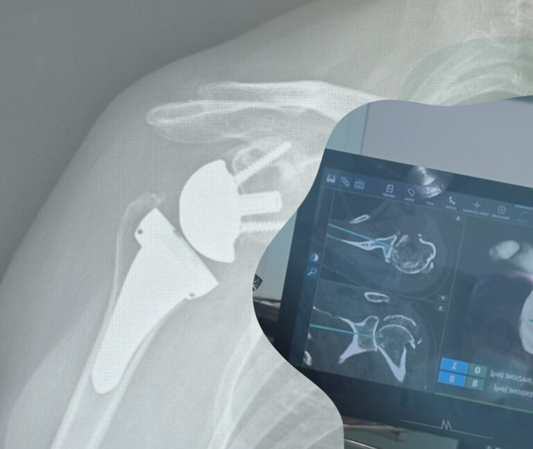 Giardella_Protesi Spalla NextAR