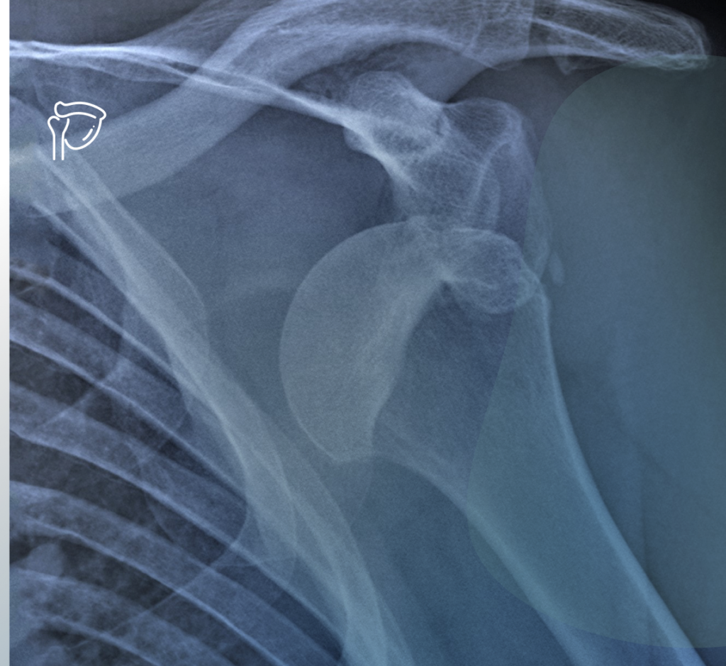 Lussazione di spalla. Quali solo le conseguenze più comuni