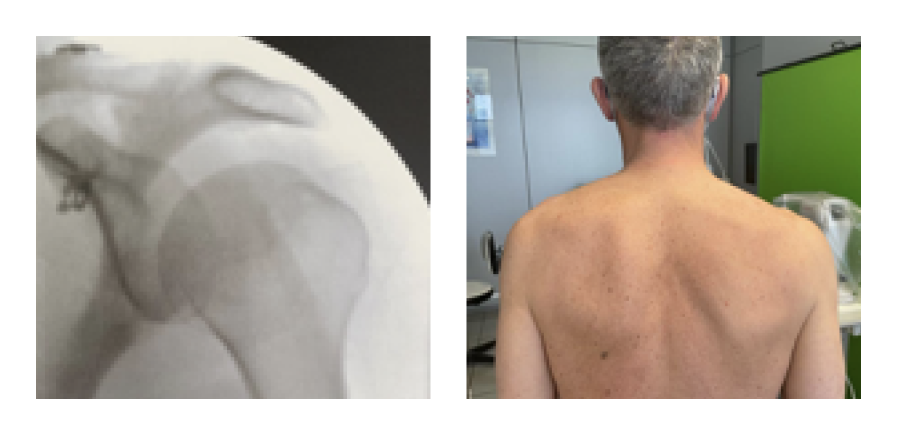 Lussazione acromion clavare intervento