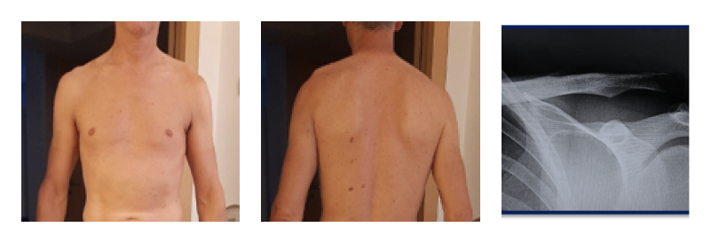 Lussazione Acromion claveare