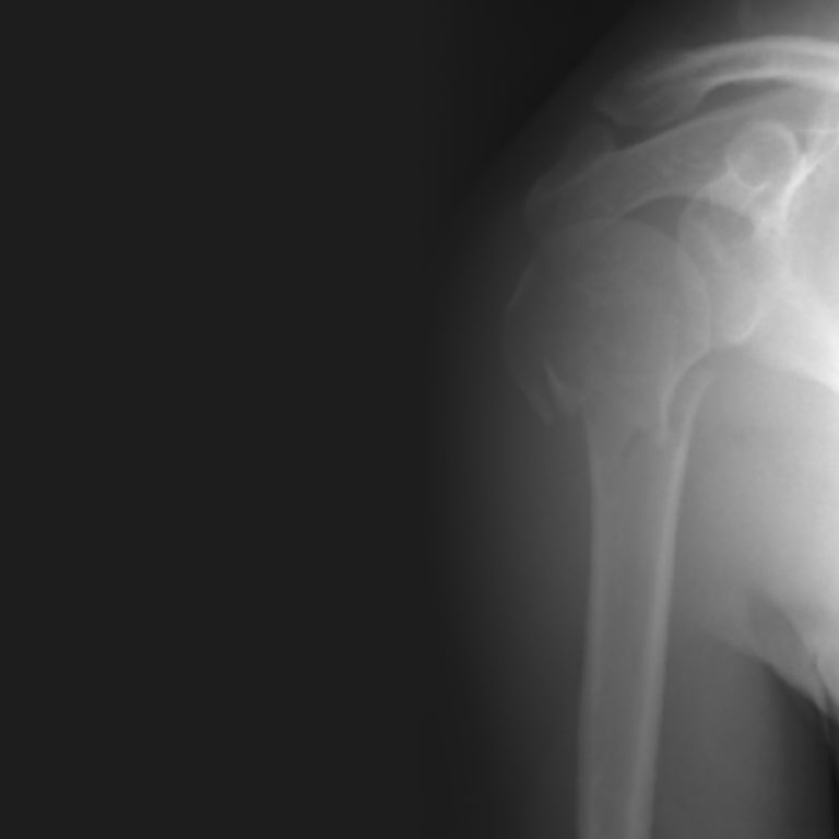 Fratture prossimali dell'omero