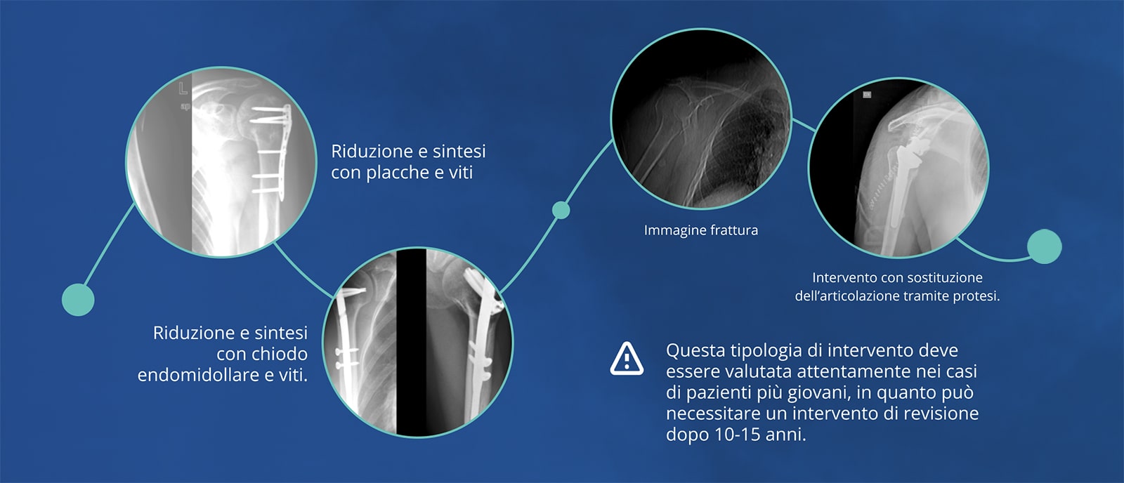 Fratture prossimali dell'omero